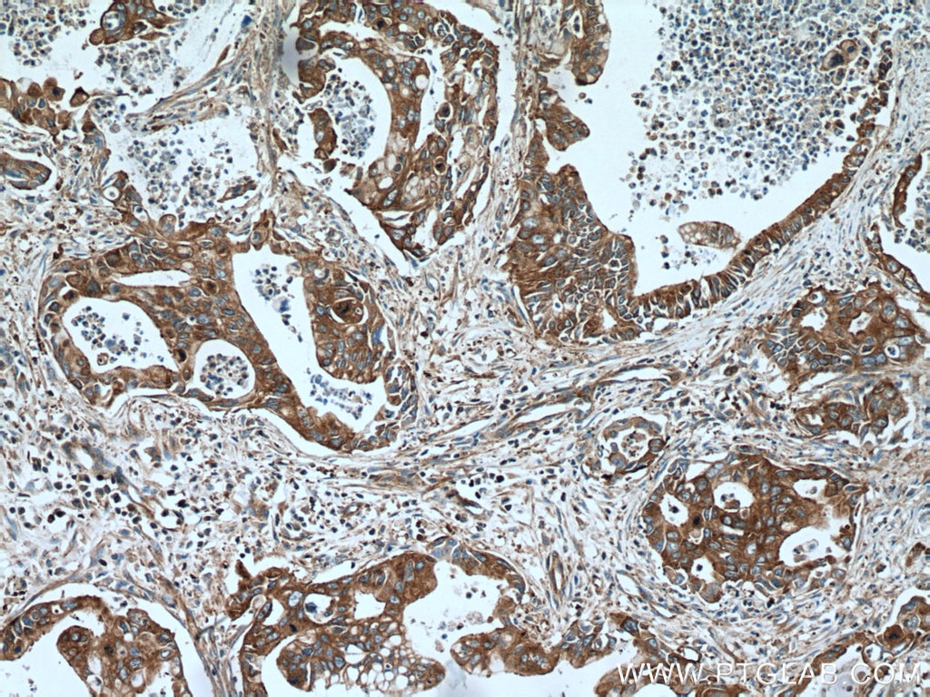 Immunohistochemistry (IHC) staining of human pancreas cancer tissue using UBR4 Polyclonal antibody (15966-1-AP)