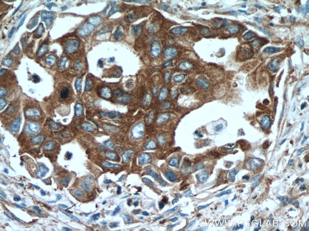 Immunohistochemistry (IHC) staining of human pancreas cancer tissue using UBR4 Polyclonal antibody (15966-1-AP)