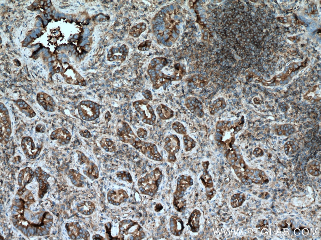 Immunohistochemistry (IHC) staining of human lung cancer tissue using UBR4 Polyclonal antibody (15966-1-AP)
