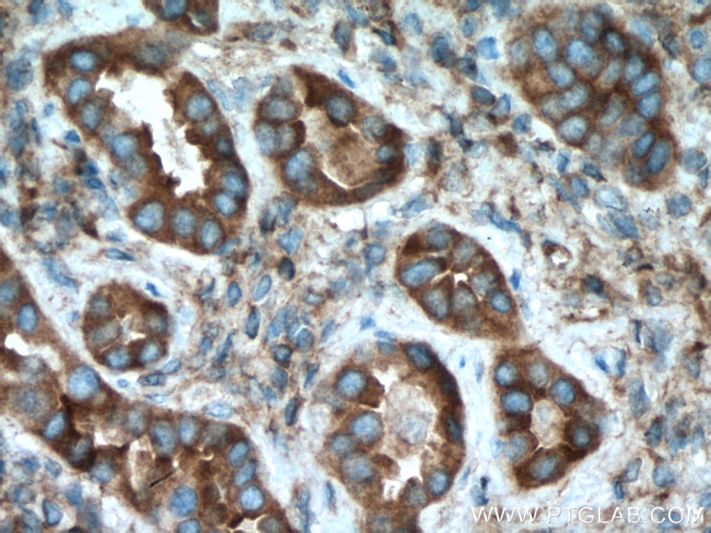 Immunohistochemistry (IHC) staining of human lung cancer tissue using UBR4 Polyclonal antibody (15966-1-AP)