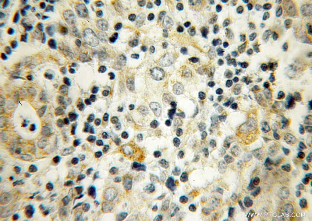 Immunohistochemistry (IHC) staining of human breast cancer tissue using UBTD2 Polyclonal antibody (13172-1-AP)