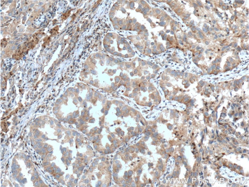 Immunohistochemistry (IHC) staining of human lung cancer tissue using UBXN11 Polyclonal antibody (13109-1-AP)