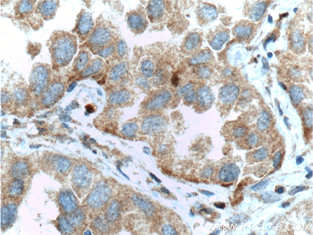 Immunohistochemistry (IHC) staining of human lung cancer tissue using UBXN11 Polyclonal antibody (13109-1-AP)