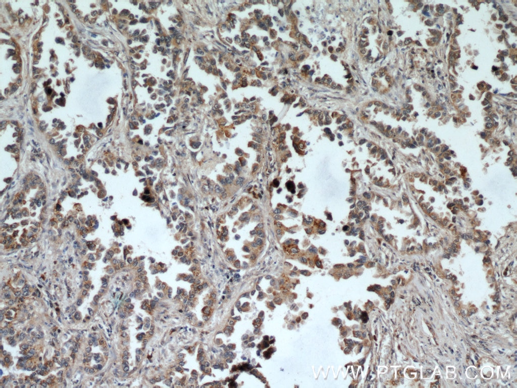 Immunohistochemistry (IHC) staining of human lung cancer tissue using UBXN11 Polyclonal antibody (13109-1-AP)