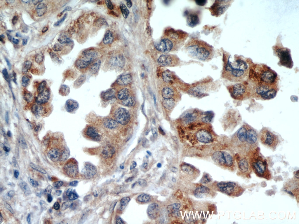 Immunohistochemistry (IHC) staining of human lung cancer tissue using UBXN11 Polyclonal antibody (13109-1-AP)