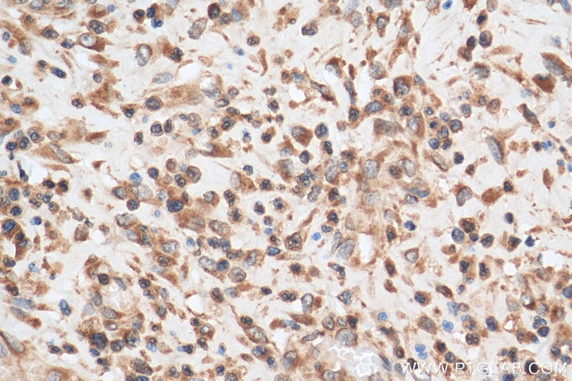 Immunohistochemistry (IHC) staining of human colon cancer tissue using UBXD2 Polyclonal antibody (21052-1-AP)