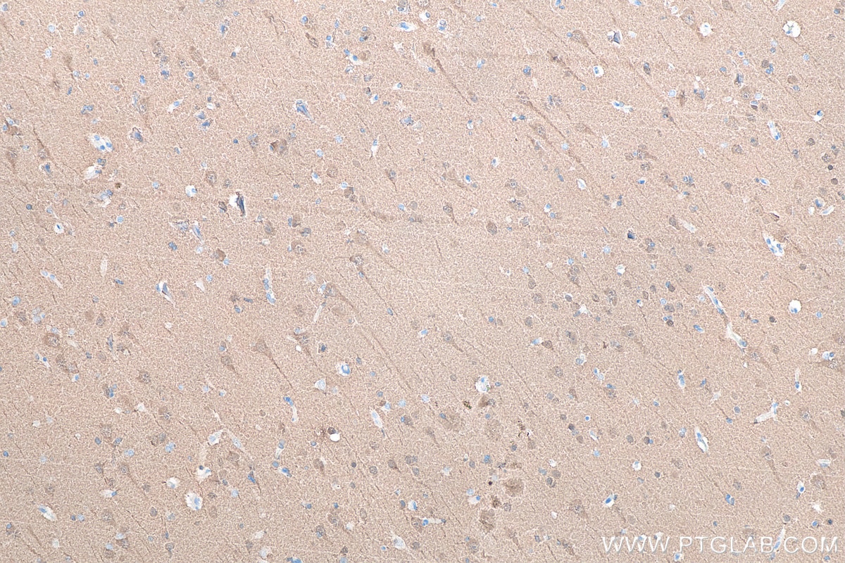 IHC staining of human gliomas using 66230-1-Ig Immunohistochemistry (IHC) staining of human gliomas tissue using UCH-L1/PGP9.5 Monoclonal antibody (66230-1-Ig)