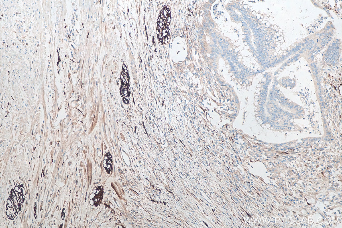IHC staining of human colon cancer using 66230-1-Ig Immunohistochemistry (IHC) staining of human colon cancer tissue using UCH-L1/PGP9.5 Monoclonal antibody (66230-1-Ig)