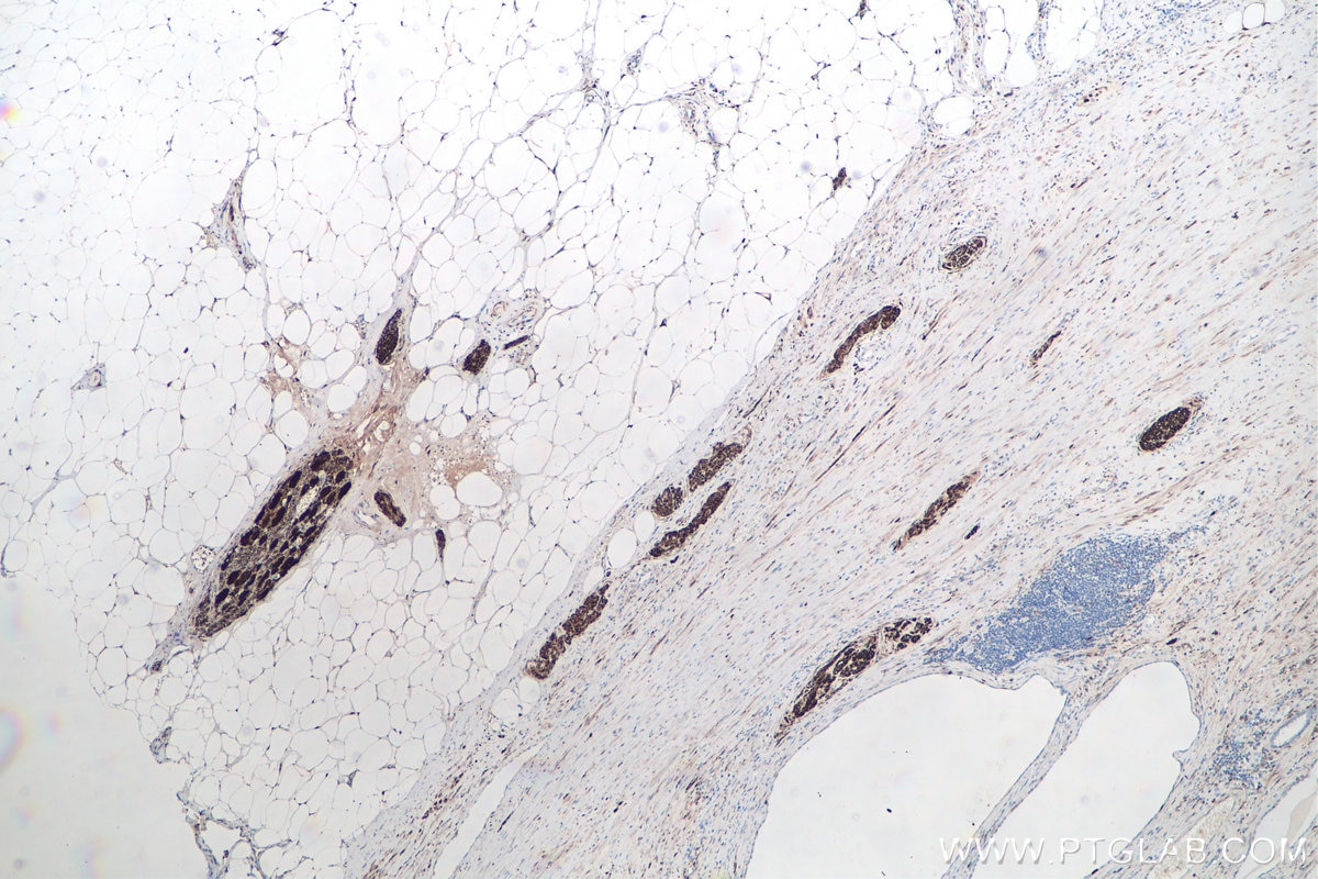 IHC staining of human prostate cancer using 66230-1-Ig Immunohistochemistry (IHC) staining of human prostate cancer tissue using UCH-L1/PGP9.5 Monoclonal antibody (66230-1-Ig)