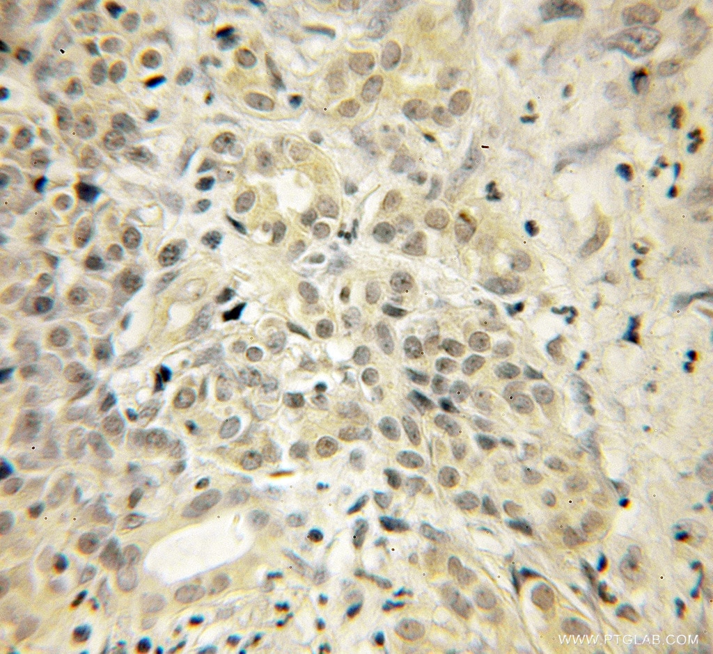 IHC staining of human pancreas cancer using 12384-1-AP