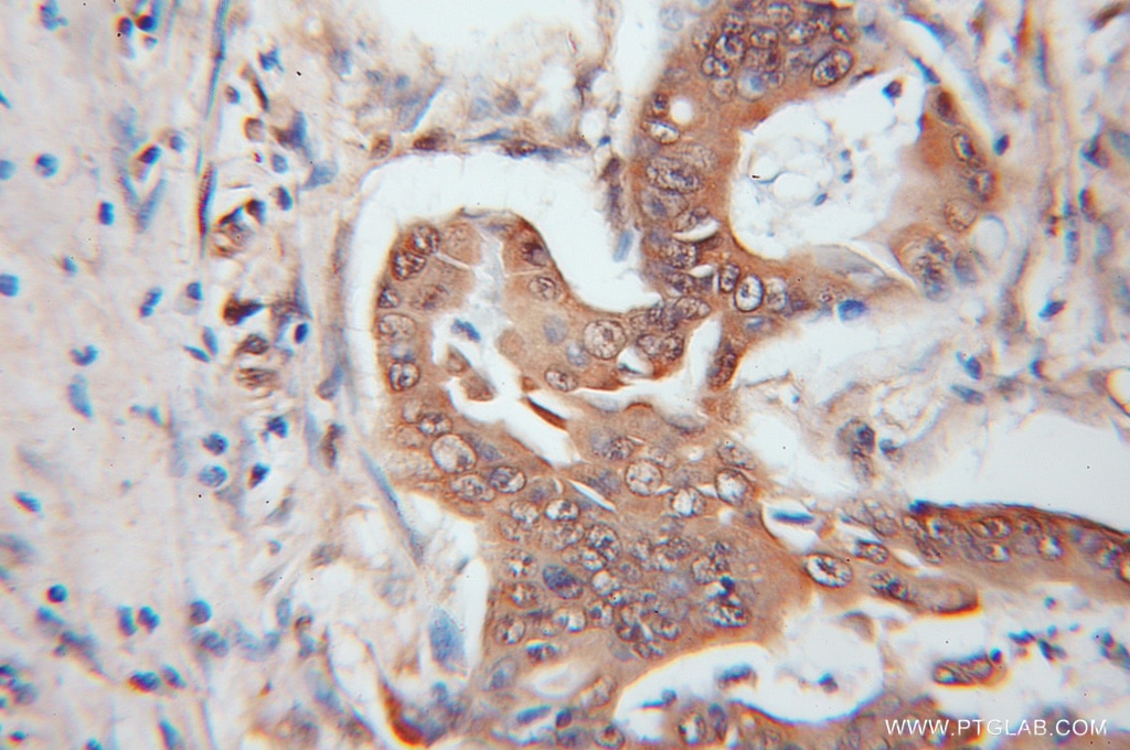 Immunohistochemistry (IHC) staining of human colon cancer tissue using UCHL5 Polyclonal antibody (11527-1-AP)