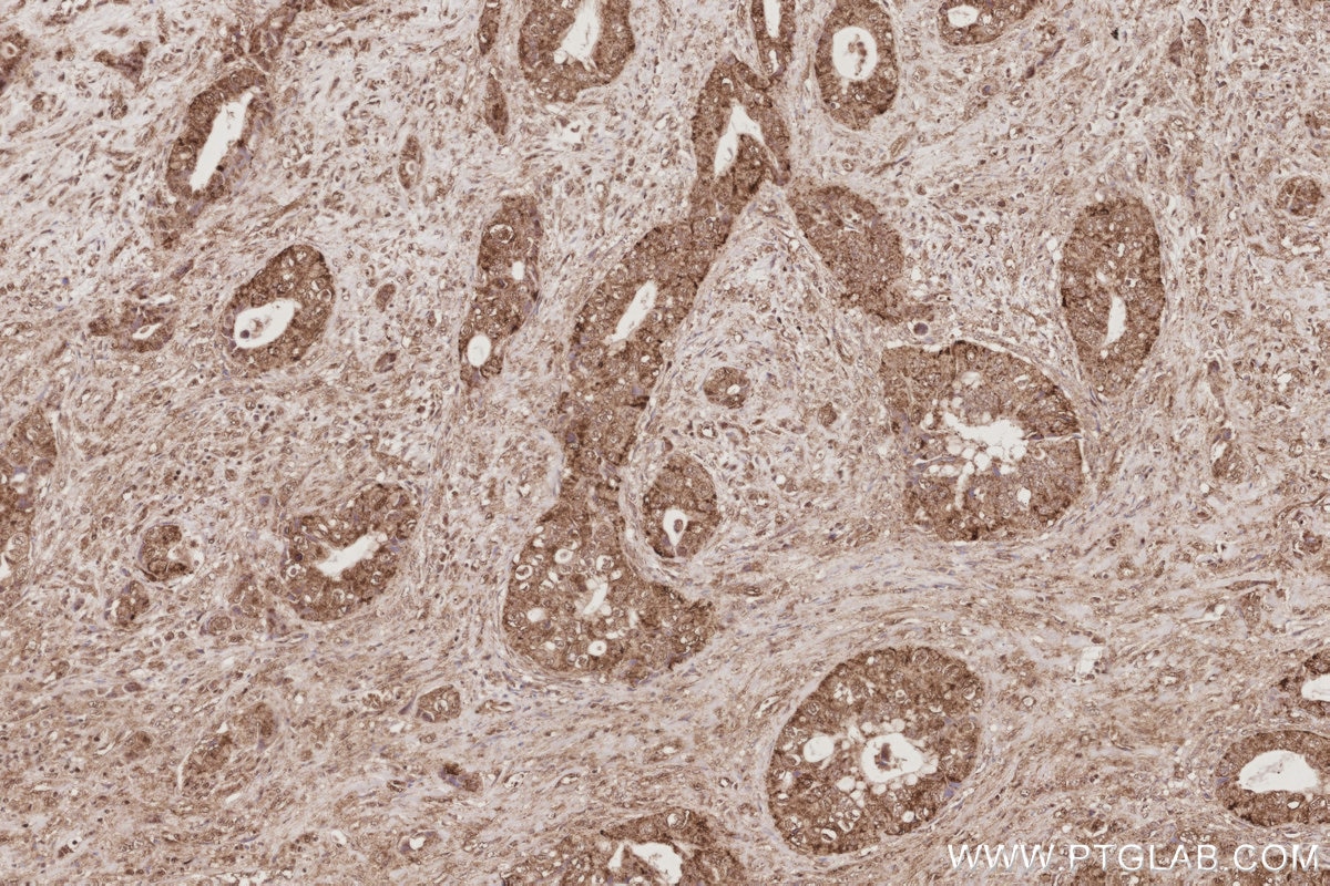 Immunohistochemistry (IHC) staining of human pancreas cancer tissue using UCHL5 Monoclonal antibody (68535-1-Ig)