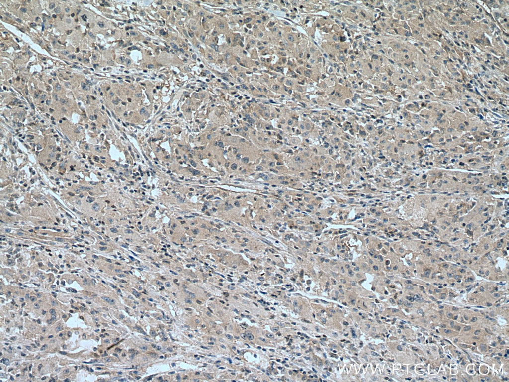 Immunohistochemistry (IHC) staining of human liver cancer tissue using UCKL1 Polyclonal antibody (28762-1-AP)