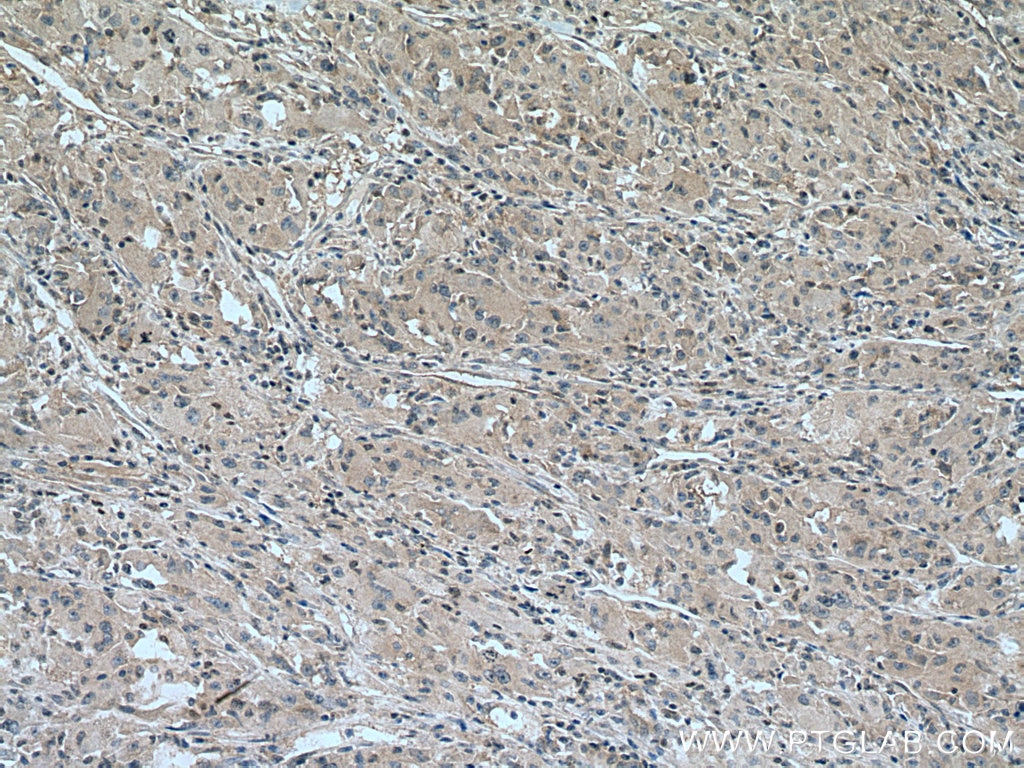 Immunohistochemistry (IHC) staining of human liver cancer tissue using UCKL1 Polyclonal antibody (28762-1-AP)