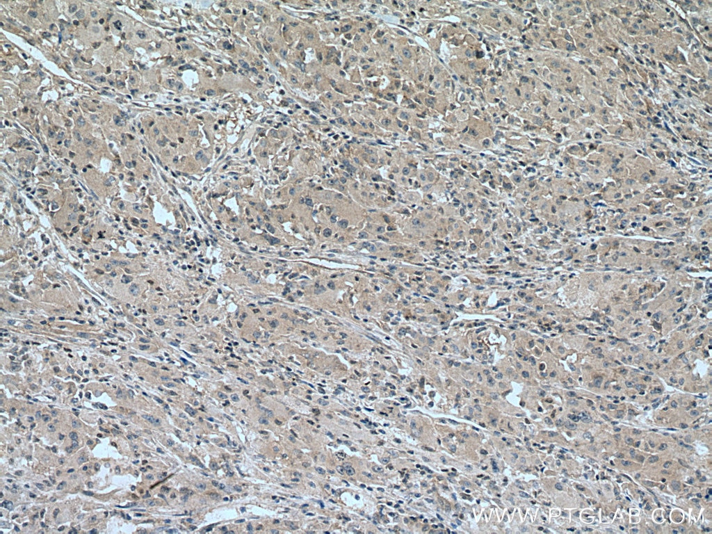 IHC staining of human liver cancer using 28762-1-AP