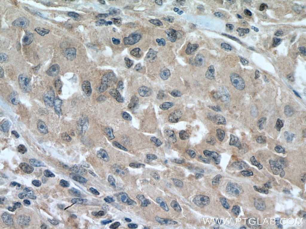 Immunohistochemistry (IHC) staining of human liver cancer tissue using UCKL1 Polyclonal antibody (28762-1-AP)