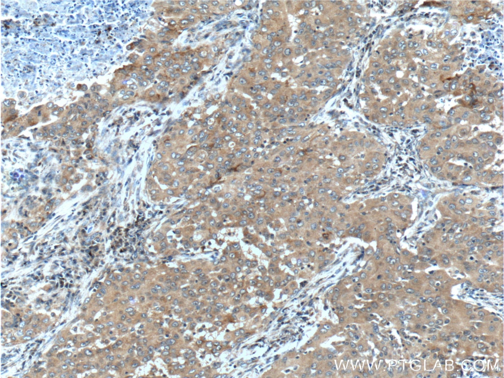 Immunohistochemistry (IHC) staining of human lung cancer tissue using UCN Polyclonal antibody (21951-1-AP)