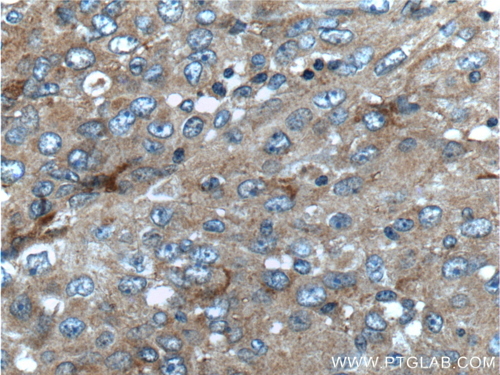 Immunohistochemistry (IHC) staining of human lung cancer tissue using UCN Polyclonal antibody (21951-1-AP)
