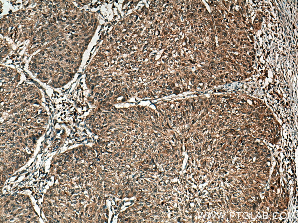 Immunohistochemistry (IHC) staining of human cervical cancer tissue using UCP2 Polyclonal antibody (11081-1-AP)
