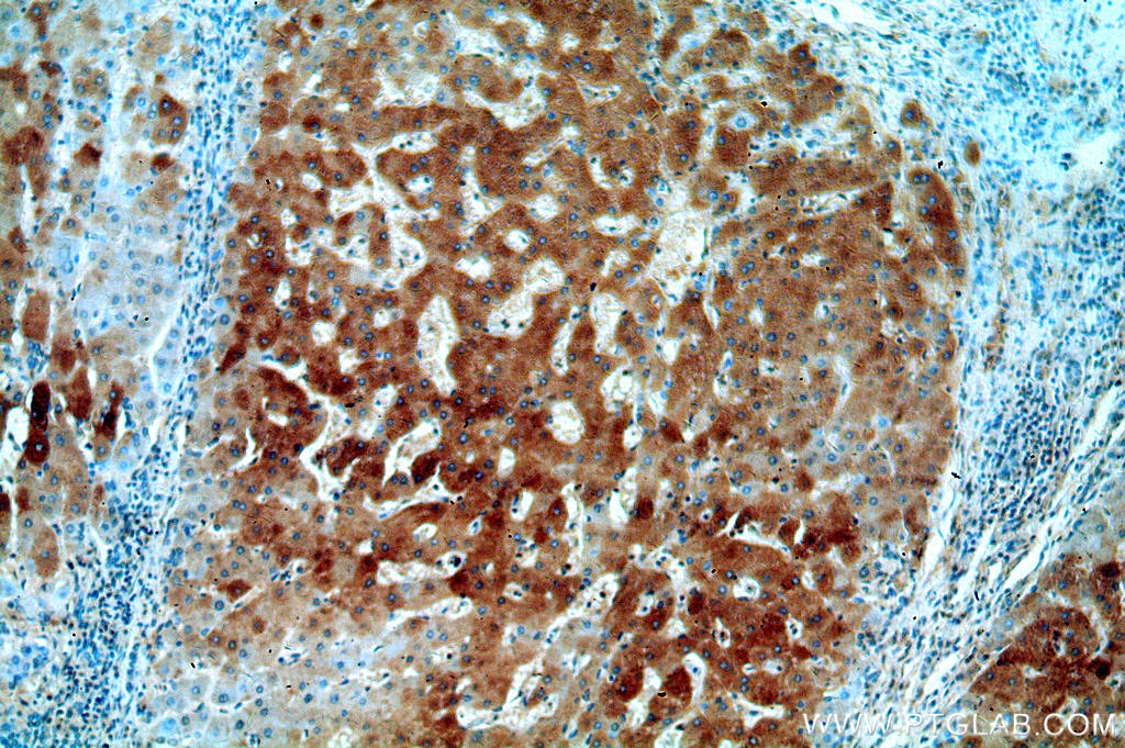 Immunohistochemistry (IHC) staining of human hepatocirrhosis tissue using UCP2 Polyclonal antibody (11081-1-AP)