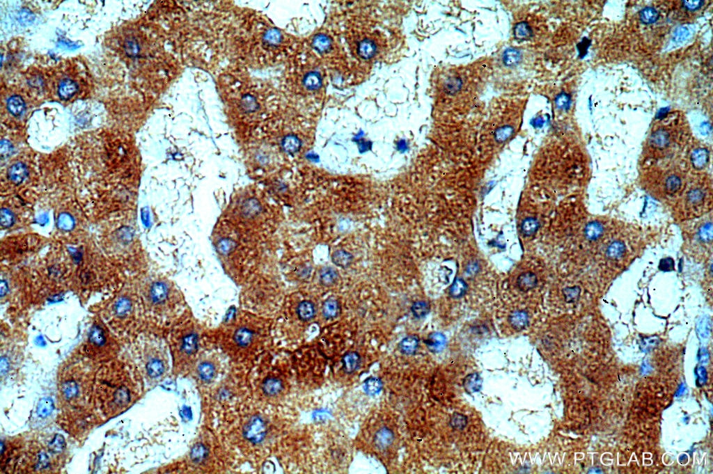 Immunohistochemistry (IHC) staining of human hepatocirrhosis tissue using UCP2 Polyclonal antibody (11081-1-AP)