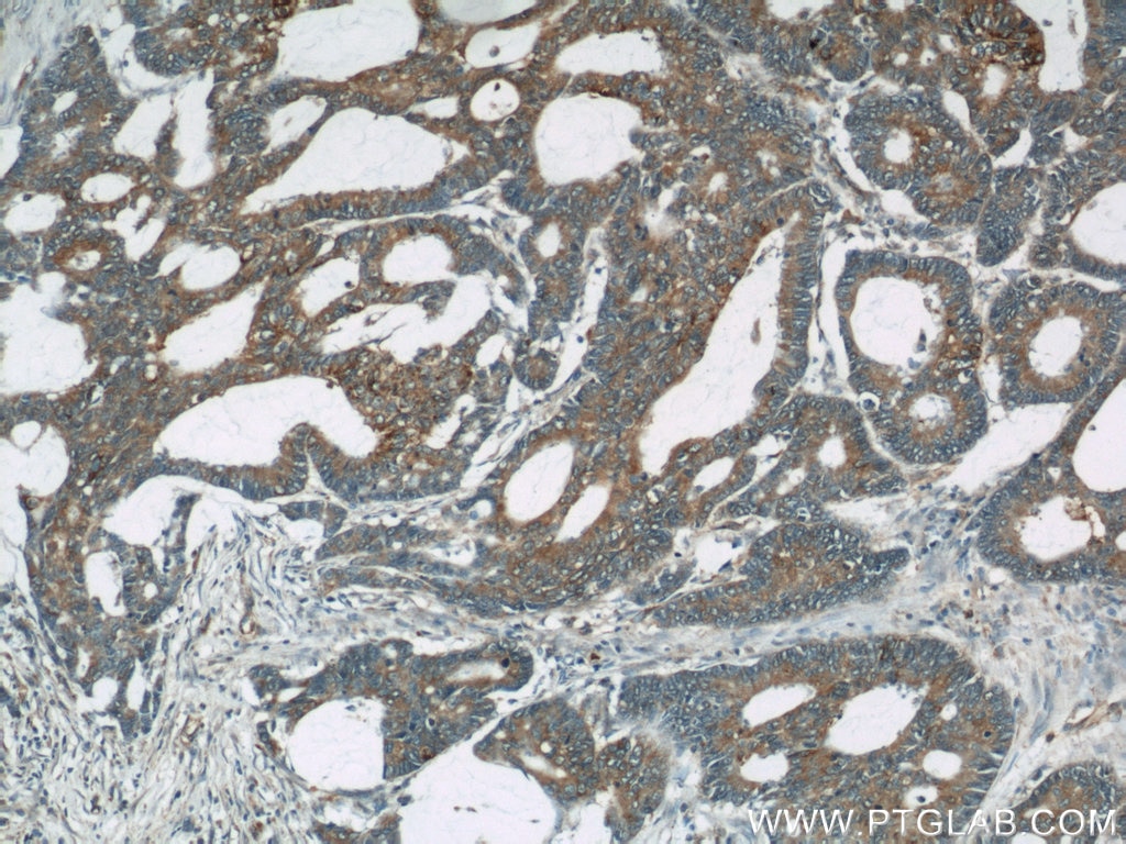 Immunohistochemistry (IHC) staining of human colon cancer tissue using UCP2 Polyclonal antibody (11081-1-AP)