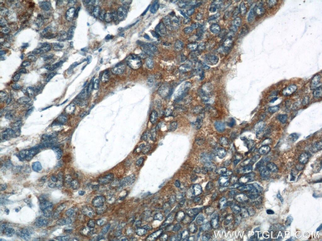 Immunohistochemistry (IHC) staining of human colon cancer tissue using UCP2 Polyclonal antibody (11081-1-AP)