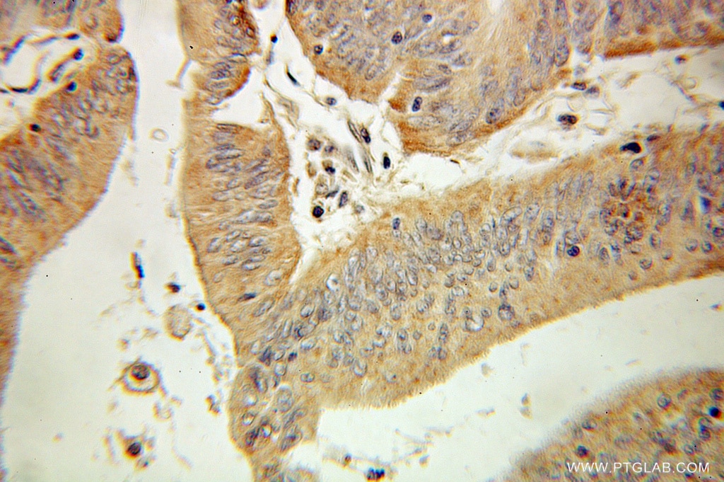 Immunohistochemistry (IHC) staining of human colon cancer tissue using UCP3 Polyclonal antibody (10750-1-AP)