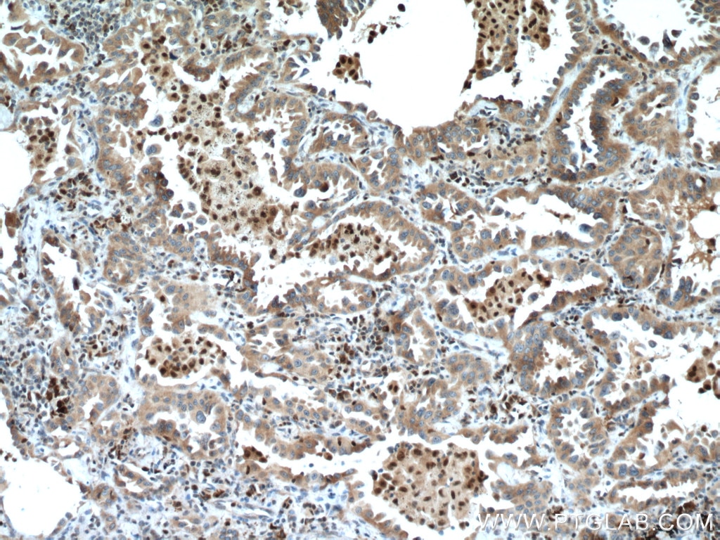 Immunohistochemistry (IHC) staining of human lung cancer tissue using UFM1 Polyclonal antibody (15883-1-AP)