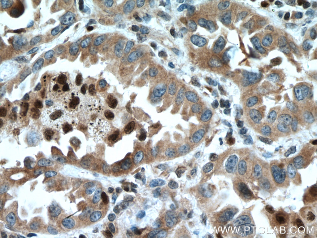 Immunohistochemistry (IHC) staining of human lung cancer tissue using UFM1 Polyclonal antibody (15883-1-AP)