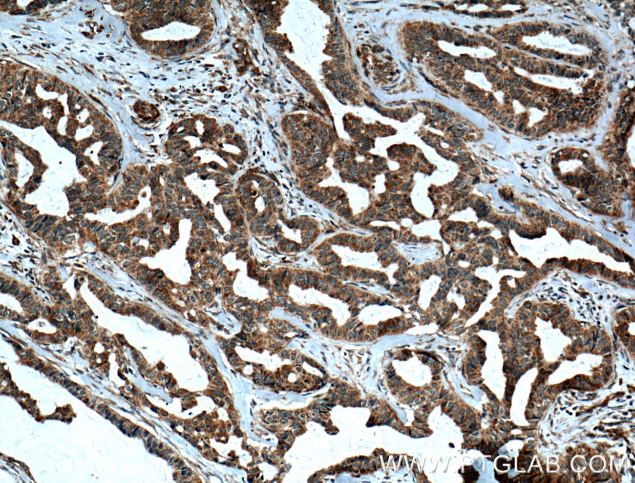 Immunohistochemistry (IHC) staining of human breast cancer tissue using UGCG Polyclonal antibody (12869-1-AP)