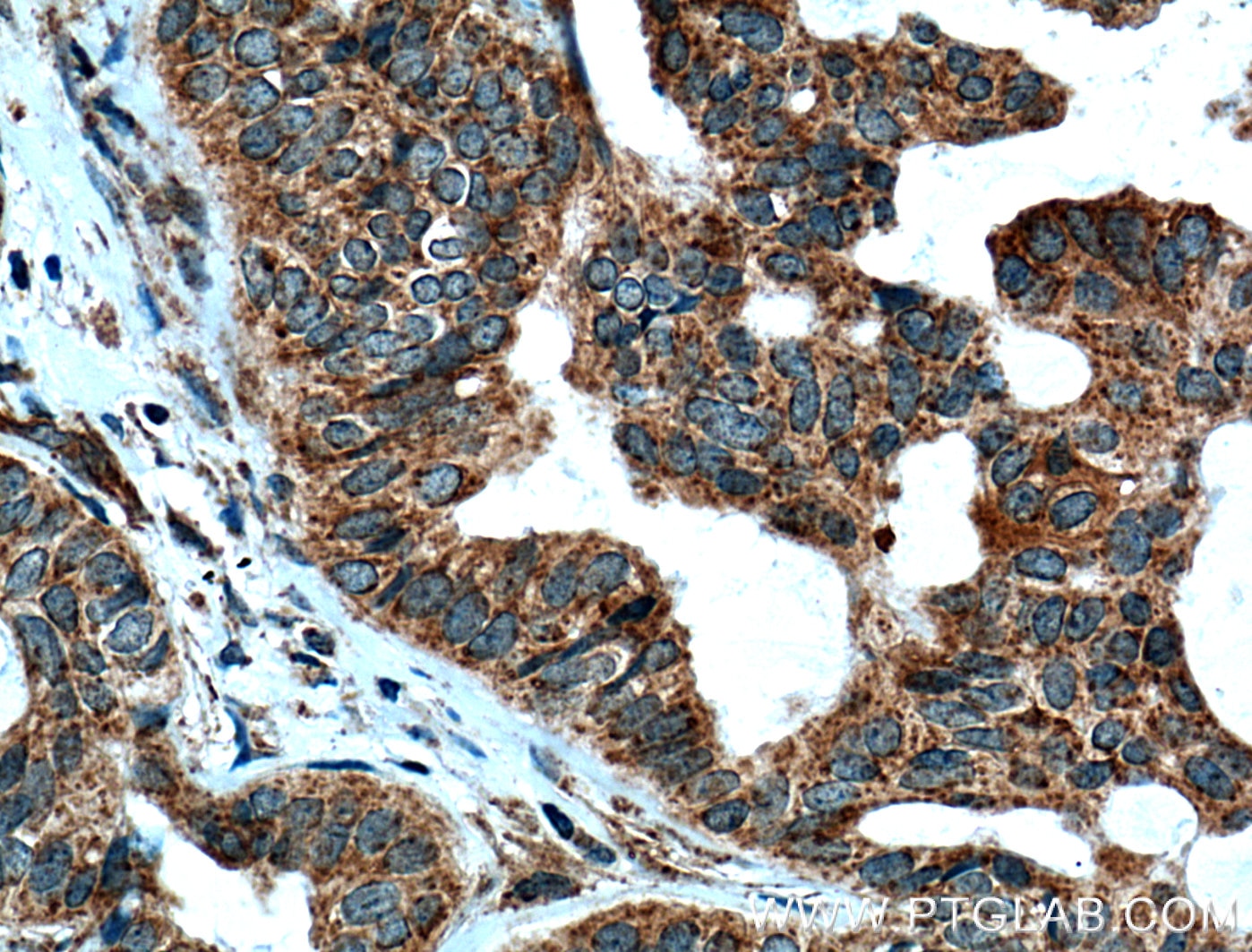 Immunohistochemistry (IHC) staining of human breast cancer tissue using UGCG Polyclonal antibody (12869-1-AP)