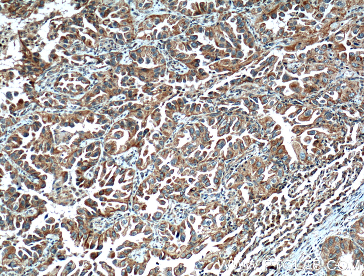 IHC staining of human lung cancer using 12869-1-AP