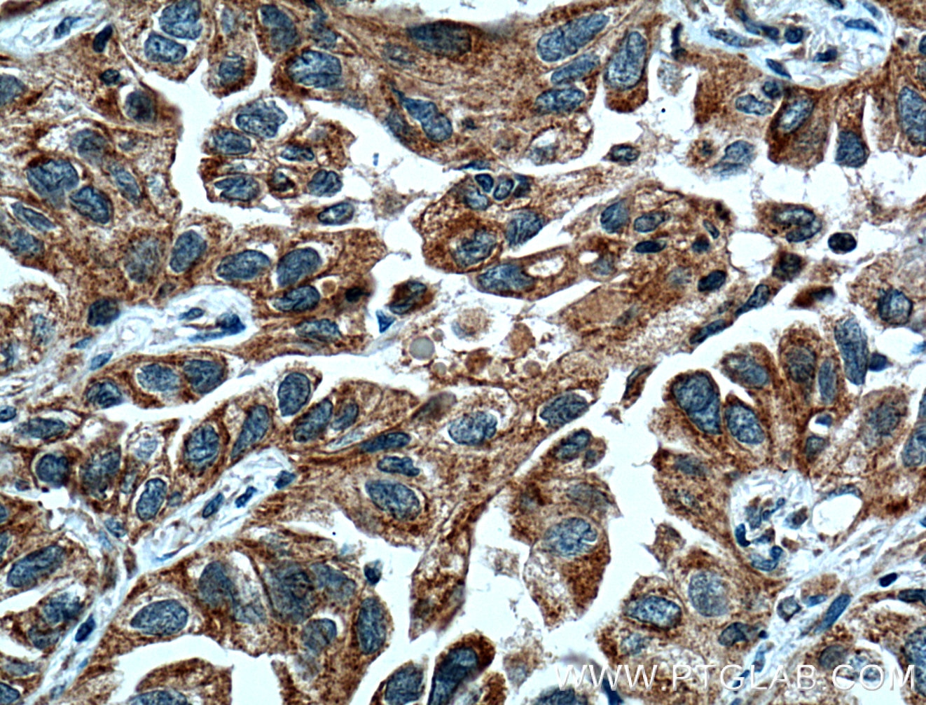 Immunohistochemistry (IHC) staining of human lung cancer tissue using UGCG Polyclonal antibody (12869-1-AP)
