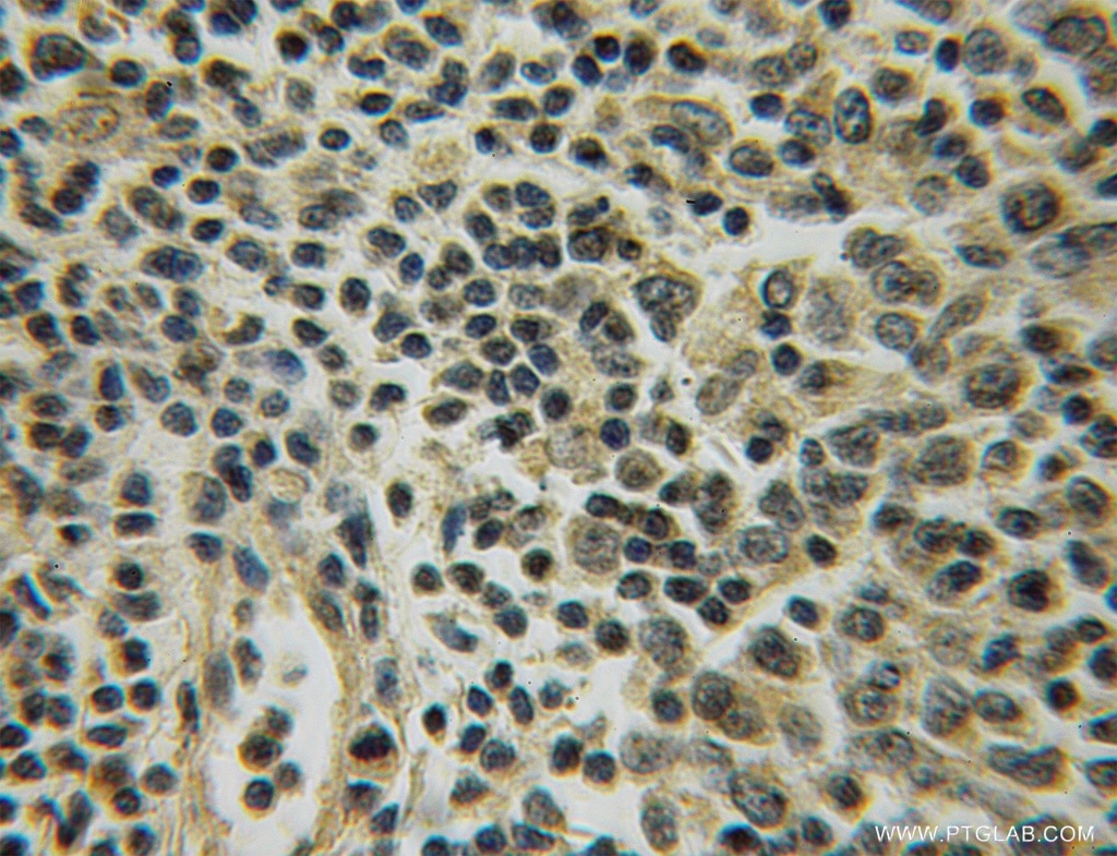 Immunohistochemistry (IHC) staining of human lymphoma tissue using UGCG Polyclonal antibody (12869-1-AP)