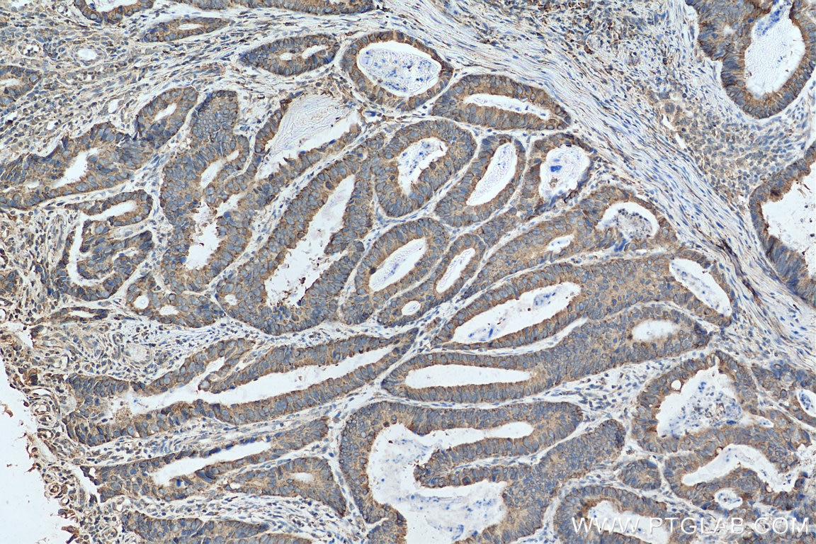 Immunohistochemistry (IHC) staining of human colon cancer tissue using UGCGL1 Polyclonal antibody (14170-1-AP)