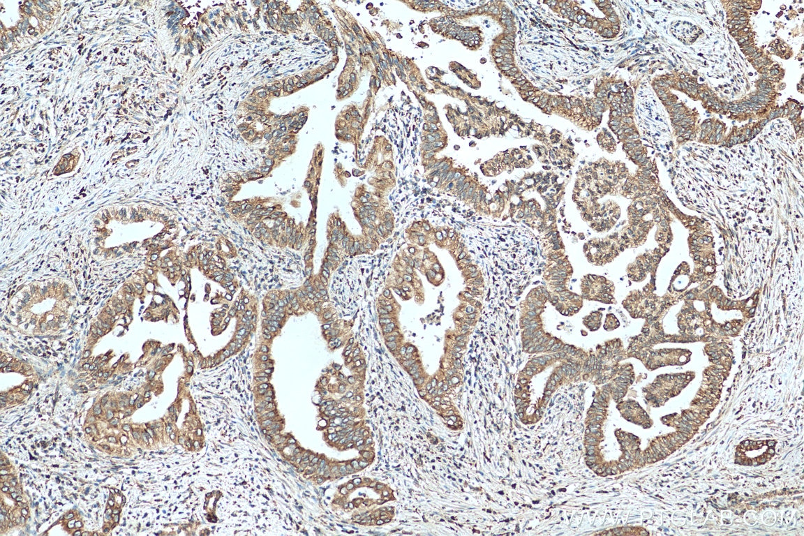 IHC staining of human pancreas cancer using 14170-1-AP