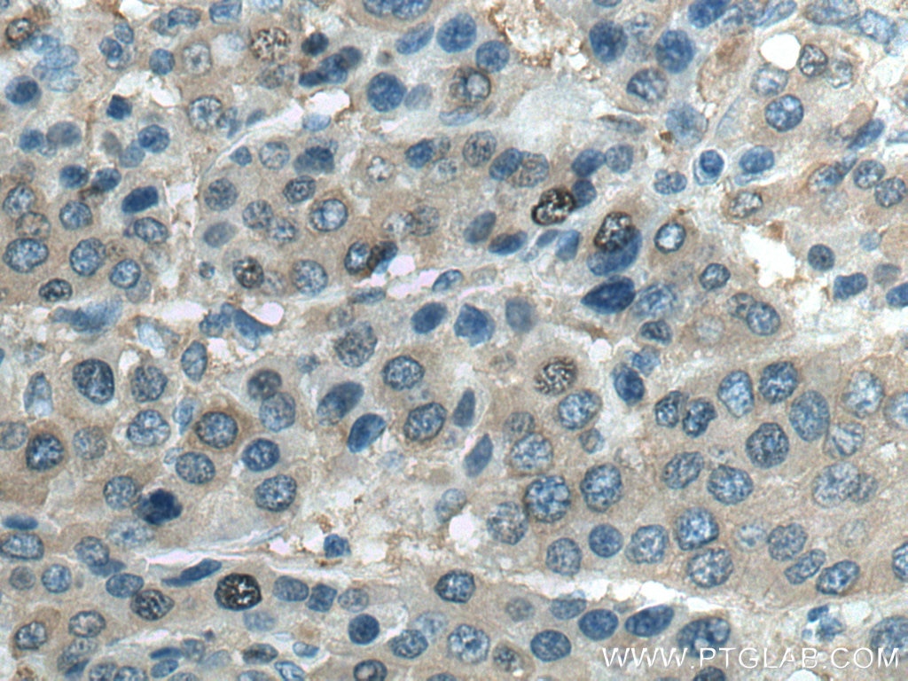 Immunohistochemistry (IHC) staining of human liver cancer tissue using UGDH Polyclonal antibody (13151-1-AP)