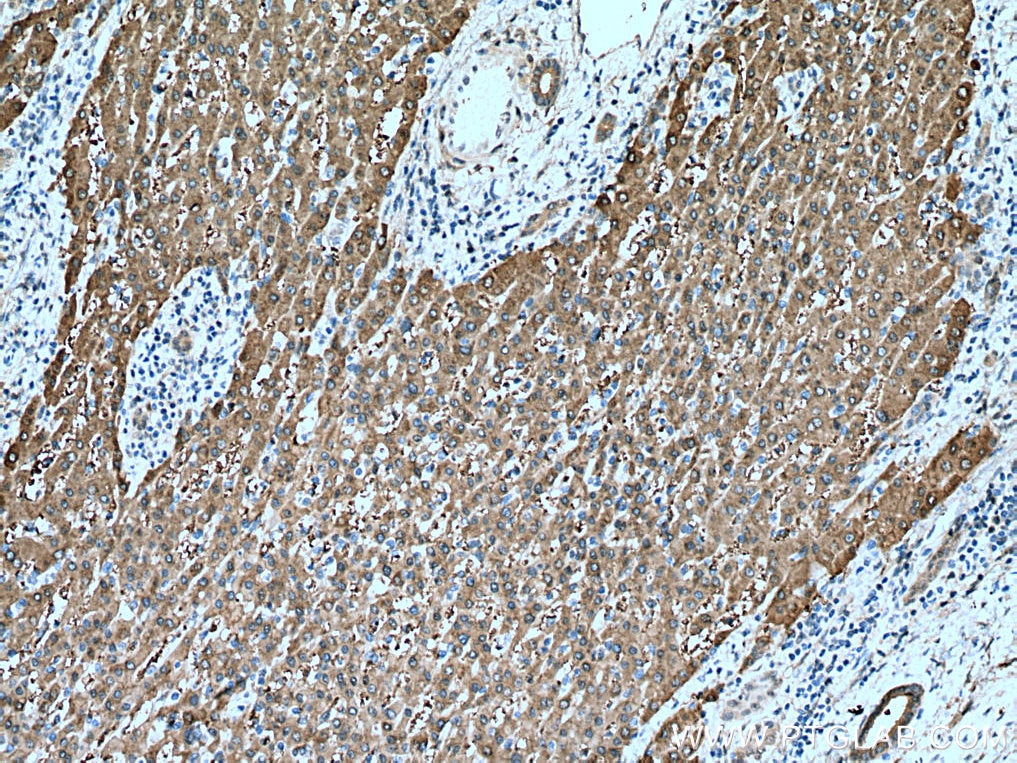 Immunohistochemistry (IHC) staining of human liver cancer tissue using UGDH Monoclonal antibody (67360-1-Ig)