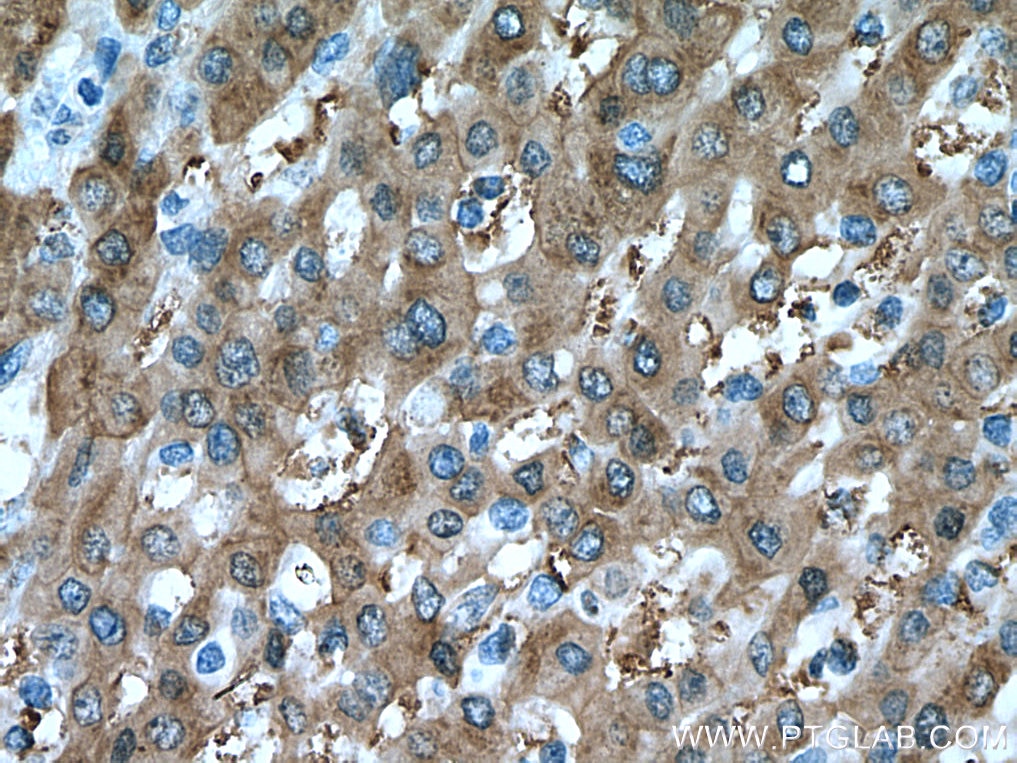 Immunohistochemistry (IHC) staining of human liver cancer tissue using UGDH Monoclonal antibody (67360-1-Ig)