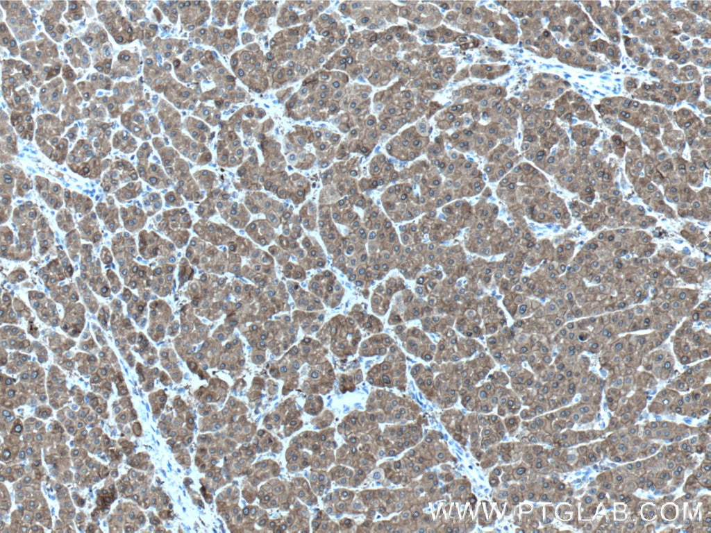 Immunohistochemistry (IHC) staining of human liver cancer tissue using UGP2 Polyclonal antibody (10391-1-AP)
