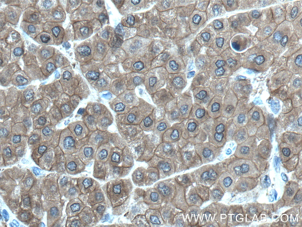 Immunohistochemistry (IHC) staining of human liver cancer tissue using UGP2 Polyclonal antibody (10391-1-AP)