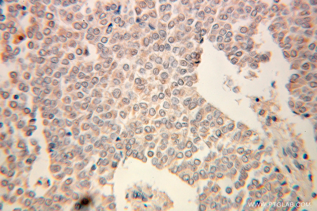 IHC staining of human ovary tumor using 10391-1-AP