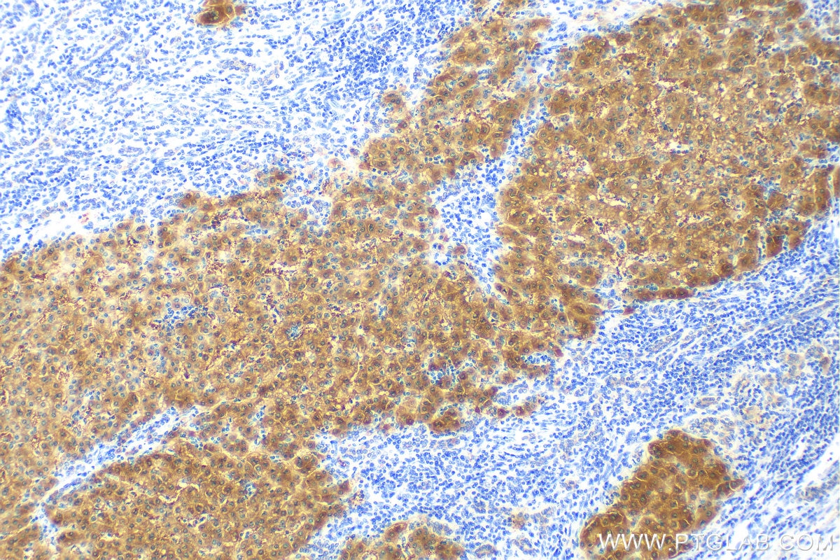 Immunohistochemistry (IHC) staining of human liver cancer tissue using UGP2 Monoclonal antibody (68381-1-Ig)