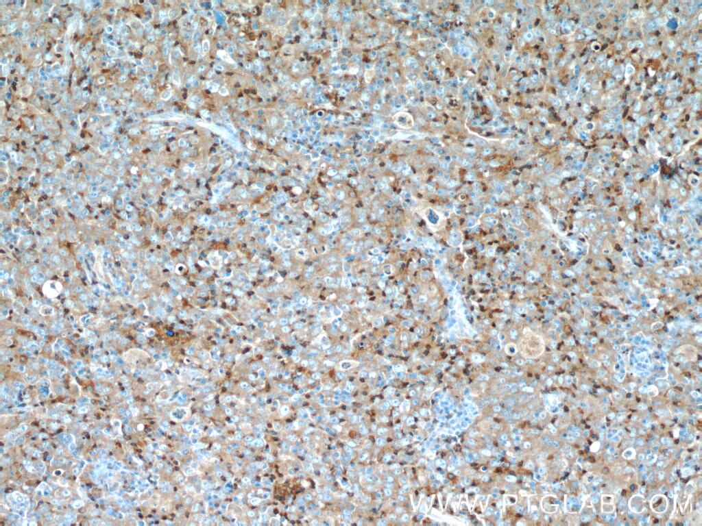 Immunohistochemistry (IHC) staining of human breast cancer tissue using UGT8 Polyclonal antibody (17982-1-AP)