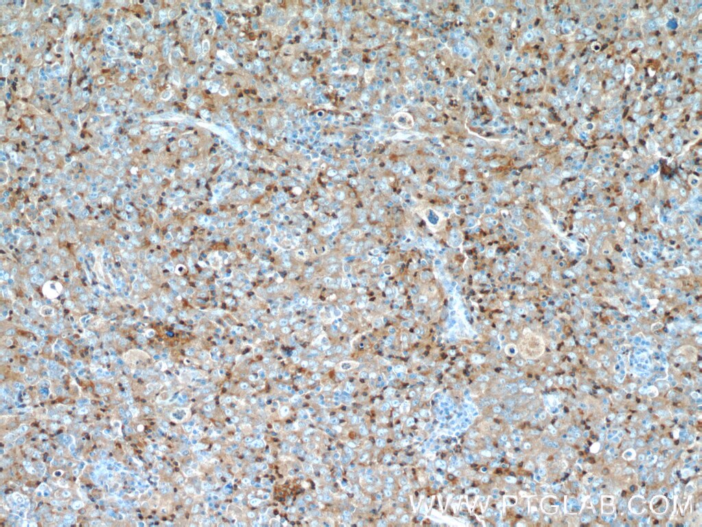 Immunohistochemistry (IHC) staining of human breast cancer tissue using UGT8 Polyclonal antibody (17982-1-AP)