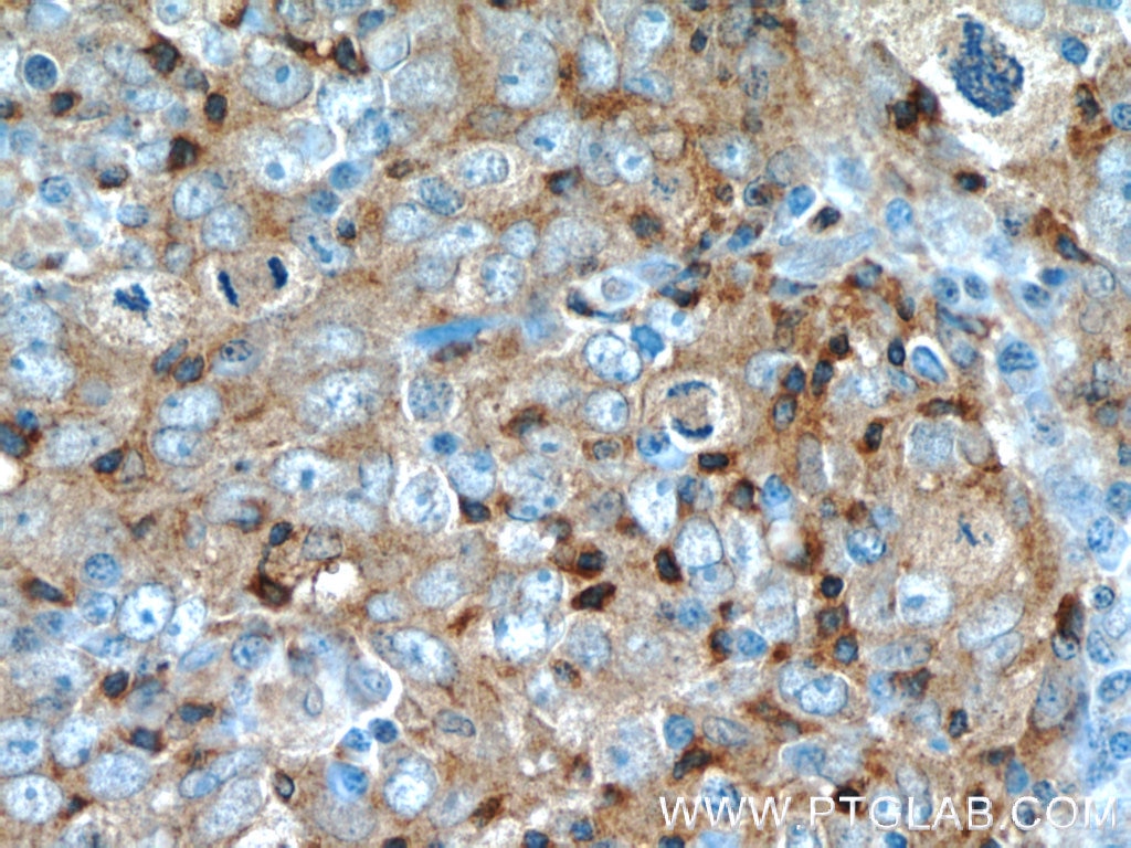 Immunohistochemistry (IHC) staining of human breast cancer tissue using UGT8 Polyclonal antibody (17982-1-AP)