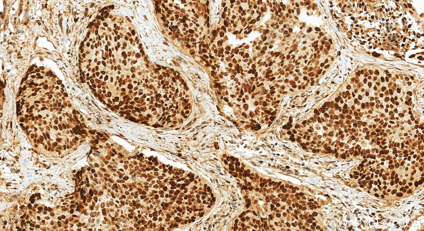 Immunohistochemistry (IHC) staining of human lung cancer tissue using UHRF1 Polyclonal antibody (21402-1-AP)