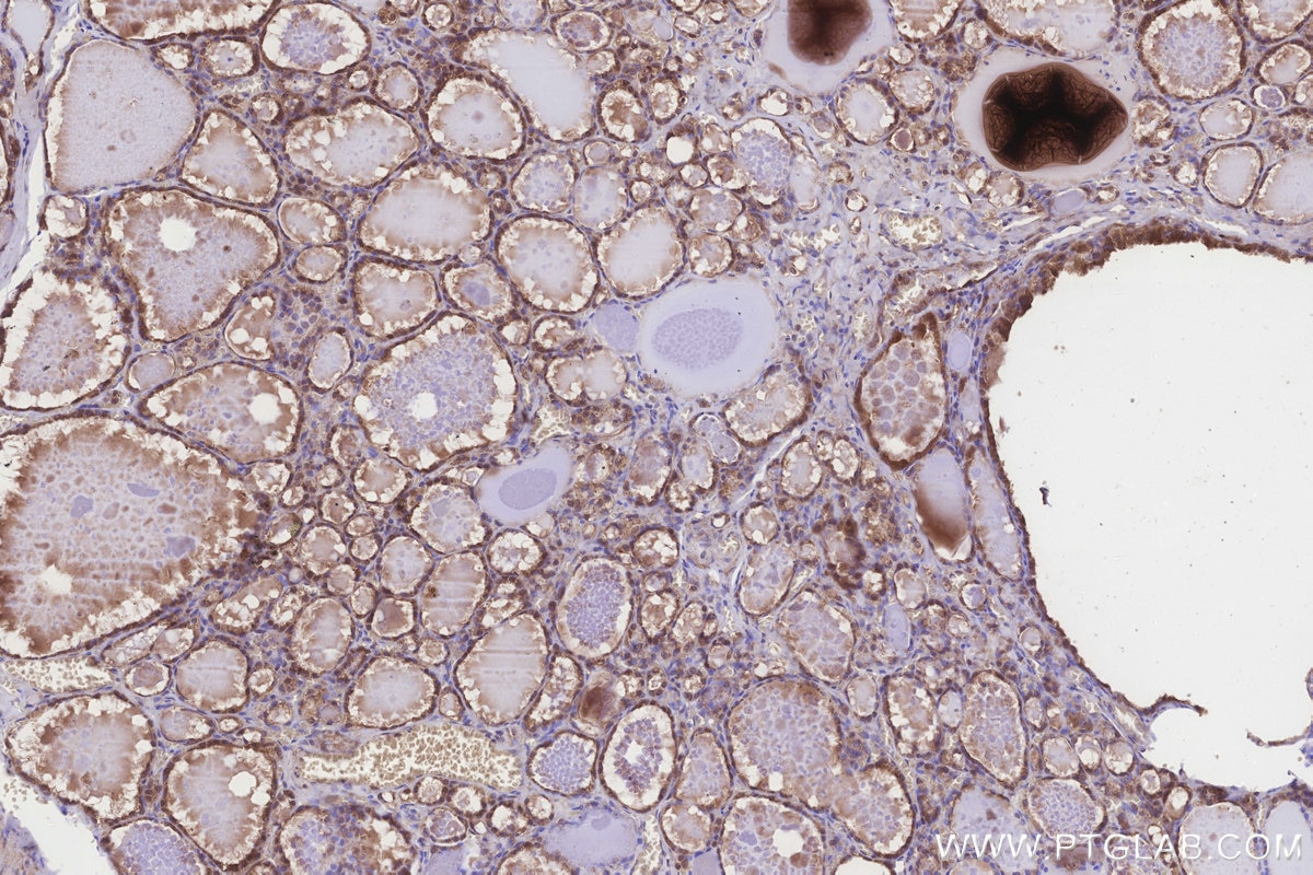 IHC staining of human thyroid cancer using 24345-1-AP Immunohistochemistry (IHC) staining of human thyroid cancer tissue using UHRF1BP1 Polyclonal antibody (24345-1-AP)