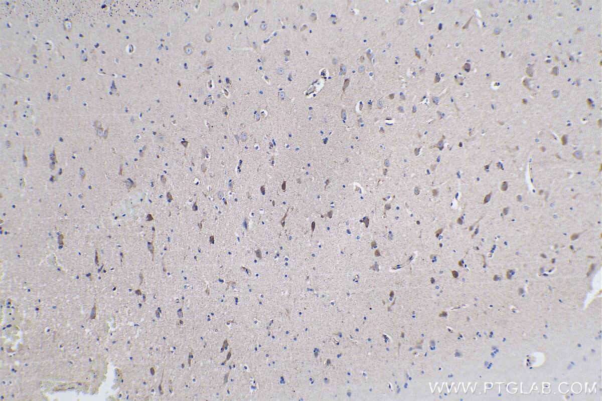 Immunohistochemistry (IHC) staining of human gliomas tissue using ULBP2 Polyclonal antibody (13133-1-AP)